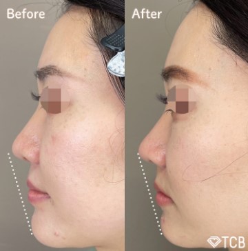 TCB東京中央美容外科の豚鼻整形の症例写真