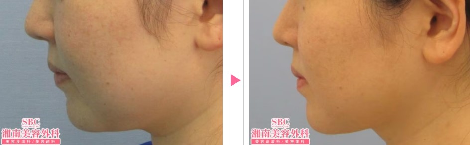 湘南美容クリニックの小顔注射の症例写真