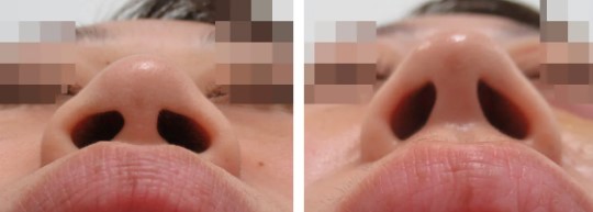 TAクリニックの鼻整形の症例写真