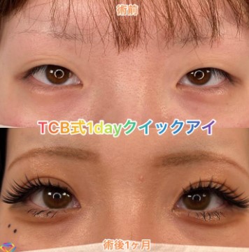 TCB東京中央美容外科　大宮西口院の二重整形症例写真