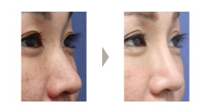 ガーデンクリニックの鼻整形の症例写真