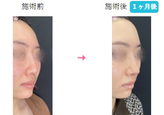 湘南美容クリニックの鼻整形の症例写真