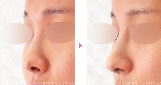 品川美容外科の鼻整形の症例写真