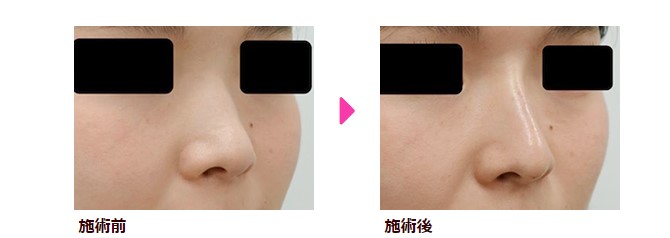 品川美容外科の鼻の症例写真