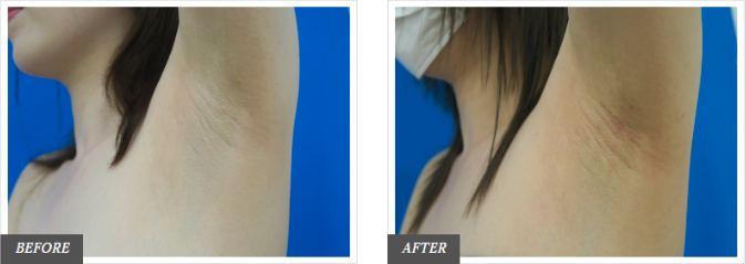 TCB東京中央美容外科のワキガ治療（ボトックス）症例写真