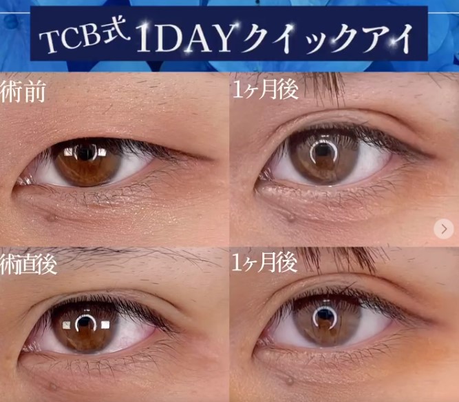 東京中央美容外科　1day クイックアイの症例写真
