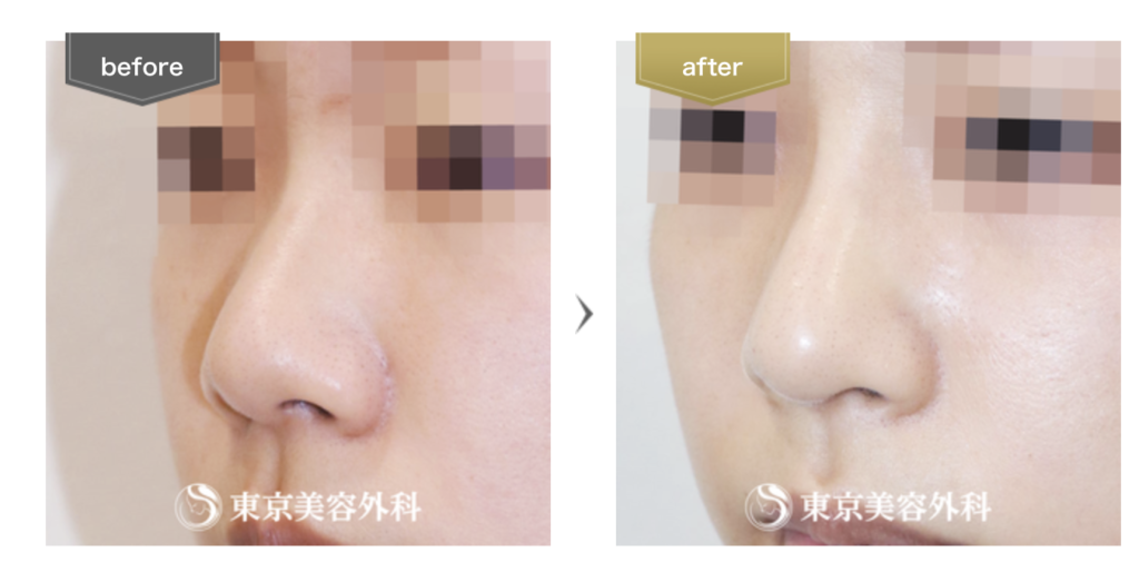 東京美容外科の鼻整形症例写真
