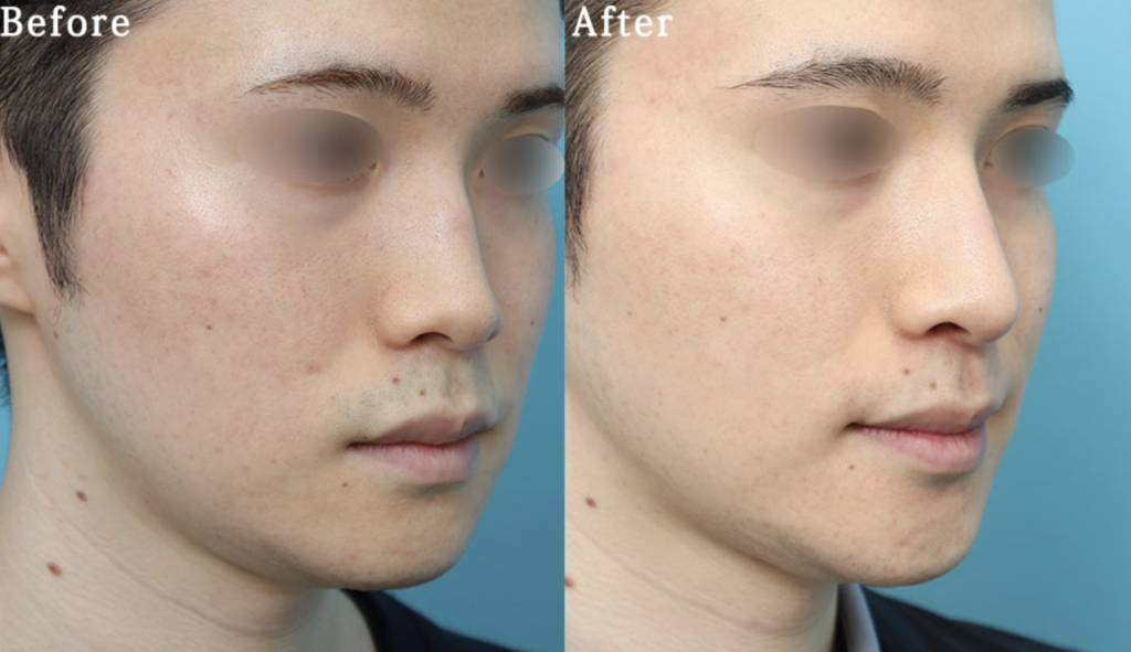 ヴェリテクリニックの鼻整形の症例写真