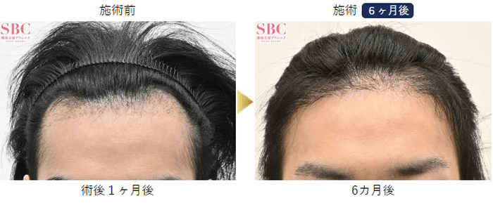 湘南AGAクリニックの自毛植毛の症例写真