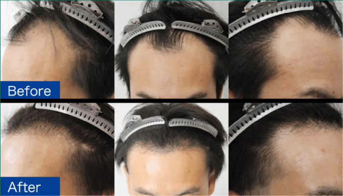 日本ウェルネス再生クリニックの自毛植毛の症例写真